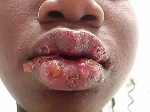 Photo Of Herpes