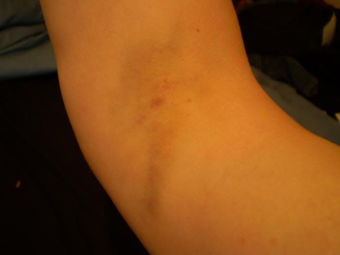 BRUISE.jpg